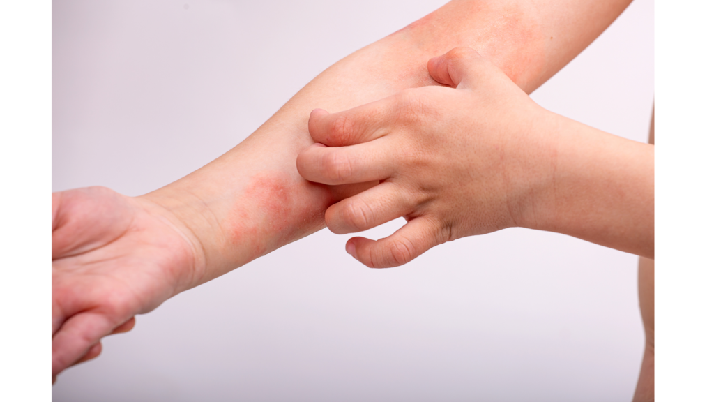 Eccema atópico o dermatitis atópica